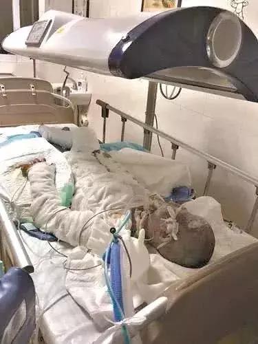 煤气泄漏导致烧伤,煤气泄漏被烧伤