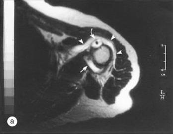 老年不明原因发热,老年人无症状发烧是怎么回事