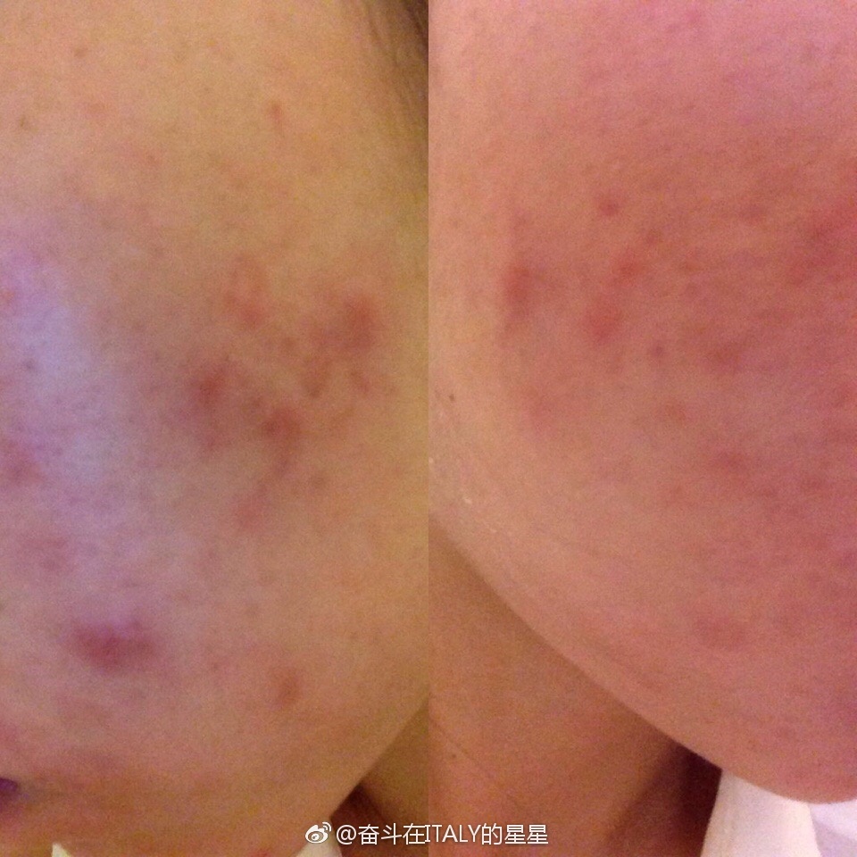 为什么别人的青春期没有痘痘？本期文章不藏私战痘好物起底