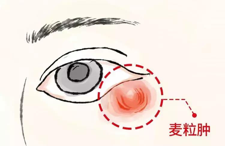 长针眼导致失明,针眼不治能自愈吗