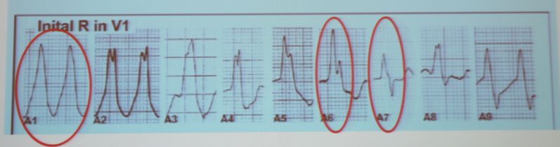 「CHC2018」郭继鸿：心电学进展2018