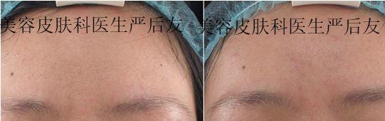 毛孔粗大如何治疗最好最快,如何治疗黑头和毛孔粗大