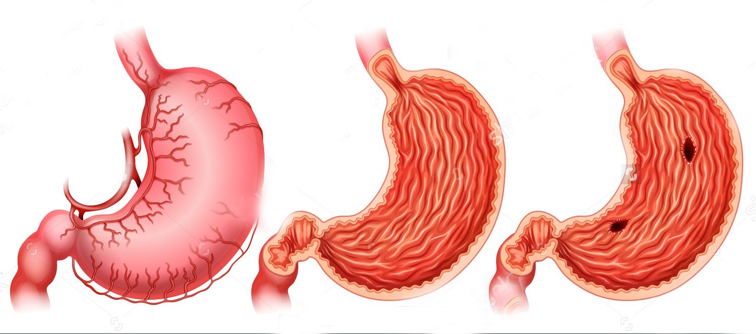 胃药5种,5类胃药要吃对了才有效