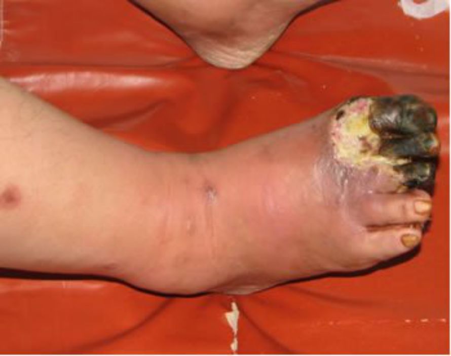 糖尿病下肢血管介入手术成功率,糖尿病下肢麻木中医辨证分析