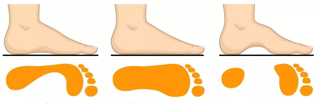 儿童轻微扁平足还需要穿矫正鞋吗,儿童扁平足x型腿如何矫正