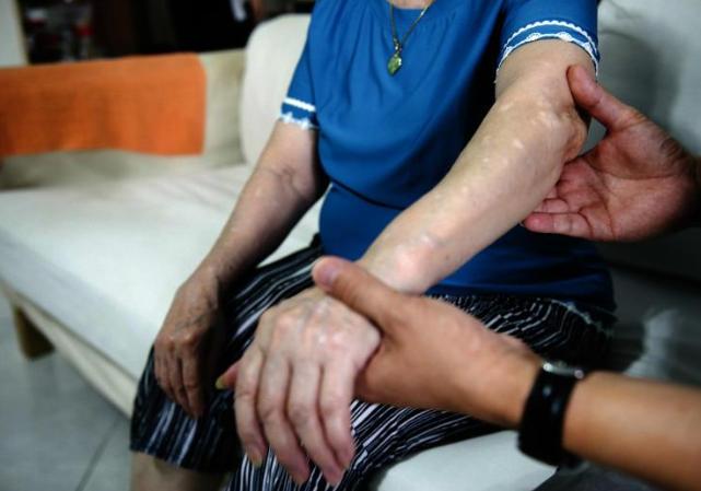 新加坡阿嫲得寄生虫幻想症,觉得浑身无时无刻爬满小虫