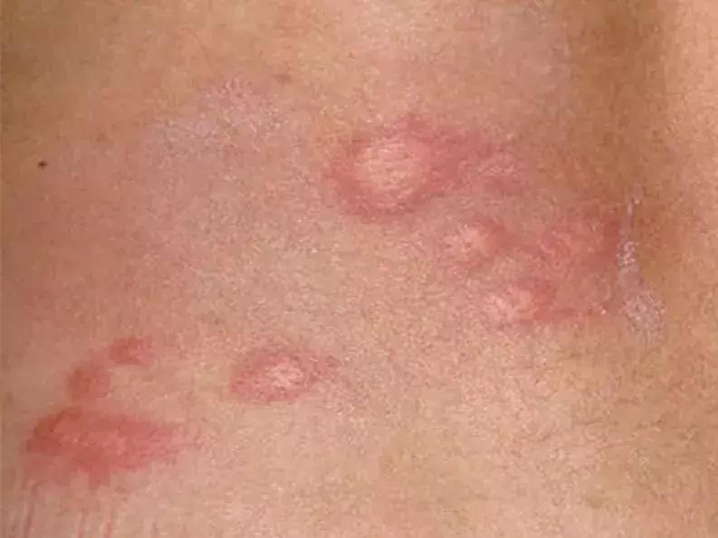 六个月宝宝湿疹皮肤破溃,宝宝起红疹破皮水泡