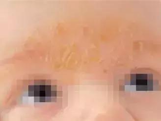 六个月宝宝湿疹皮肤破溃,宝宝起红疹破皮水泡