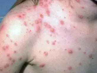 宝宝长小疹子后溃烂,宝宝的红疹子溃烂了