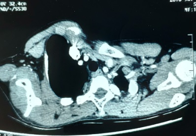 重度漏斗胸手术怎么做,胸廓畸形导致缺氧能做手术吗