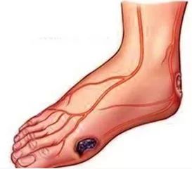 糖尿病足的皮肤,糖尿病足早期信号