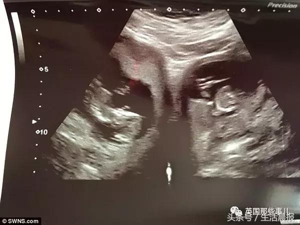 天生一对怀二胎女儿,有人天生有两个子宫吗