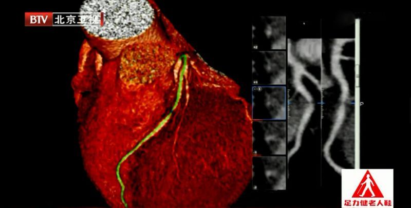 警惕血脂异常的3个信号,血脂异常的十大征兆