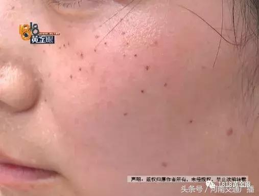 去医院取痣花了1000多元,女孩点痣8000元