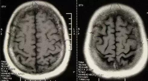 小脑萎缩的中医治疗与调养之道,老人小脑萎缩的症状与治疗方法