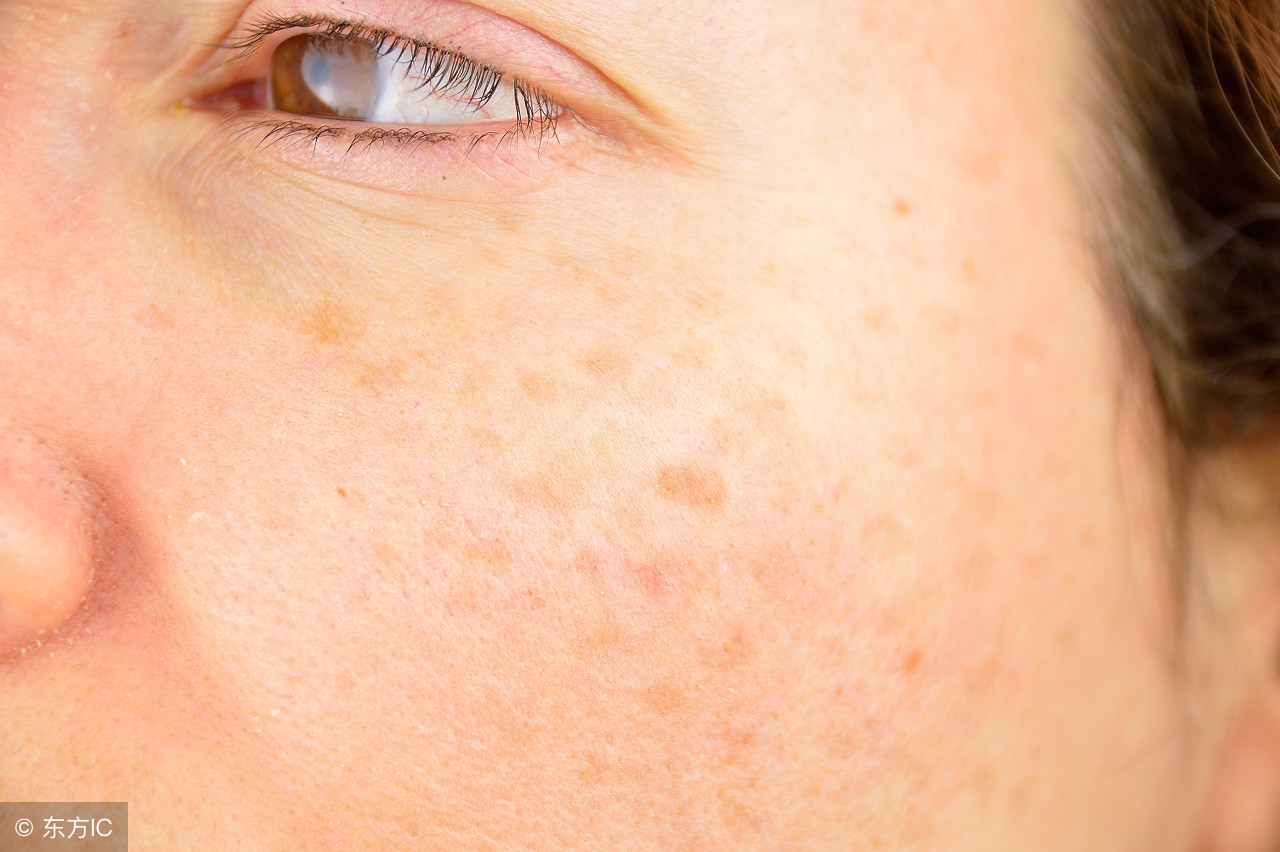 男士雀斑的治疗方法,雀斑样痣最新治疗方法