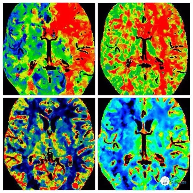 天坛医院住院日记,颈内动脉c5到c7段狭窄微创手术