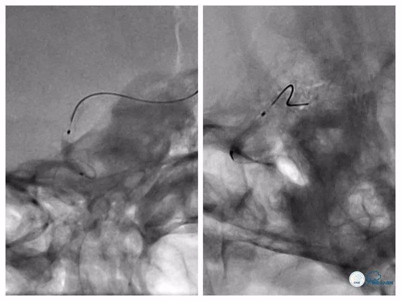 天坛医院住院日记,颈内动脉c5到c7段狭窄微创手术