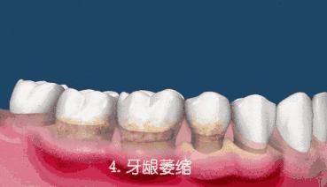 科普牙齿健康知识,牙齿不疼也需要治疗吗