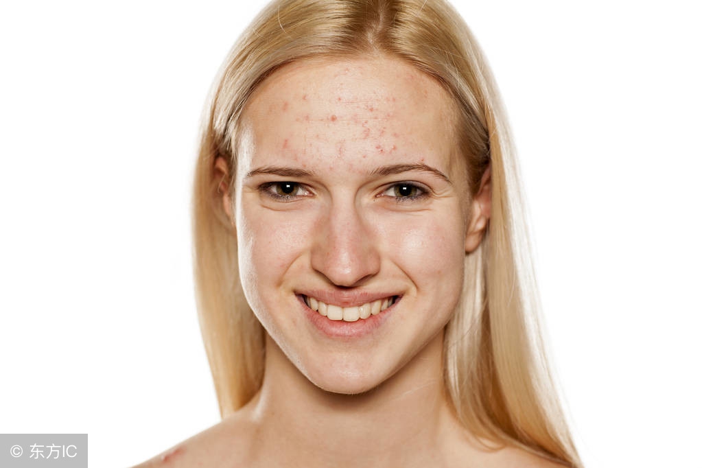 脸上长痘是五脏不健康！吃两物清热解毒，改善青春痘