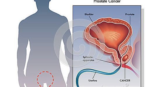 好消息靶向药纳入医保,前列腺癌的最新靶向药物有哪些