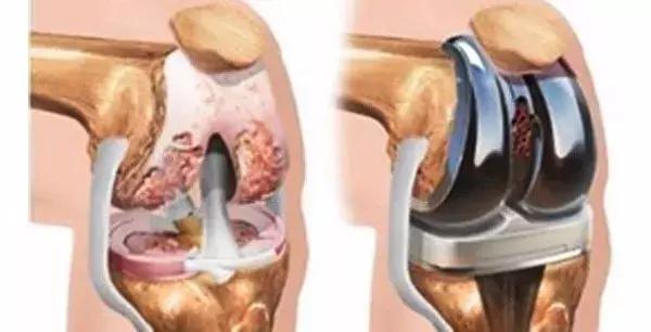 膝关节有轻微卡住的感觉怎么办,膝关节像被卡住疼痛怎么办