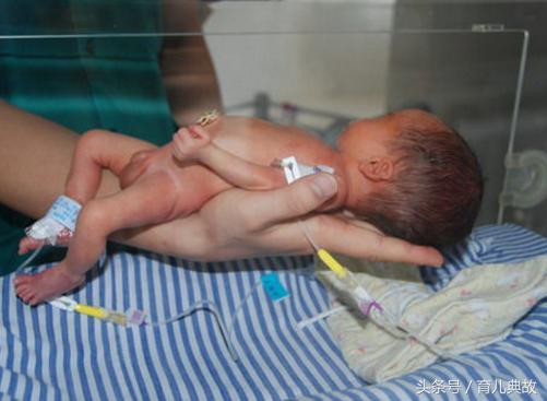 90后孕妇三胞胎早产,怀孕七八个月早产存活率