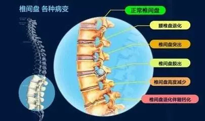 贴秘制膏药治疗腰间盘突出可信度,腰椎间盘突出贴膏药的正确位置图