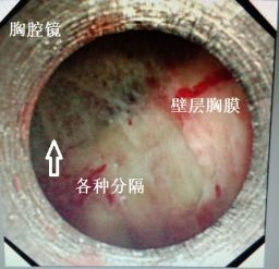 胸水抽了为什么还呼吸困难,胸水抽不出来了怎么回事