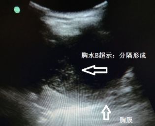 胸水为什么会抽不到,胸水抽了为什么还呼吸困难