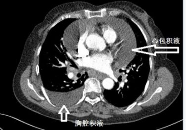 胸水抽了为什么还呼吸困难,胸水抽不出来了怎么回事