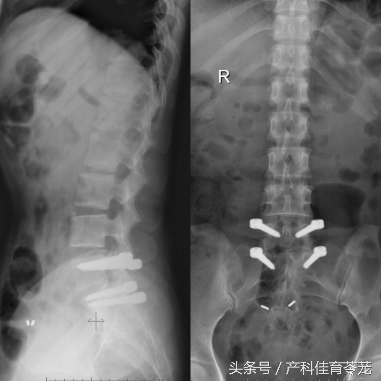 椎间盘突出如何保养防复发,椎间盘突出手术复发后中医治疗