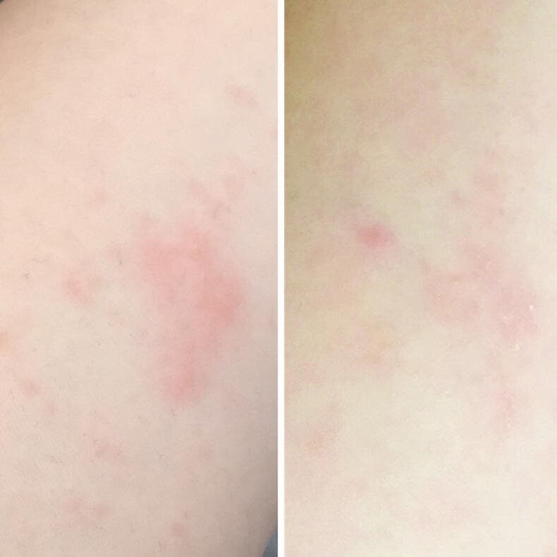 多维度评测｜网红宝宝痱子水贝亲桃叶水是真的一抹就有效？