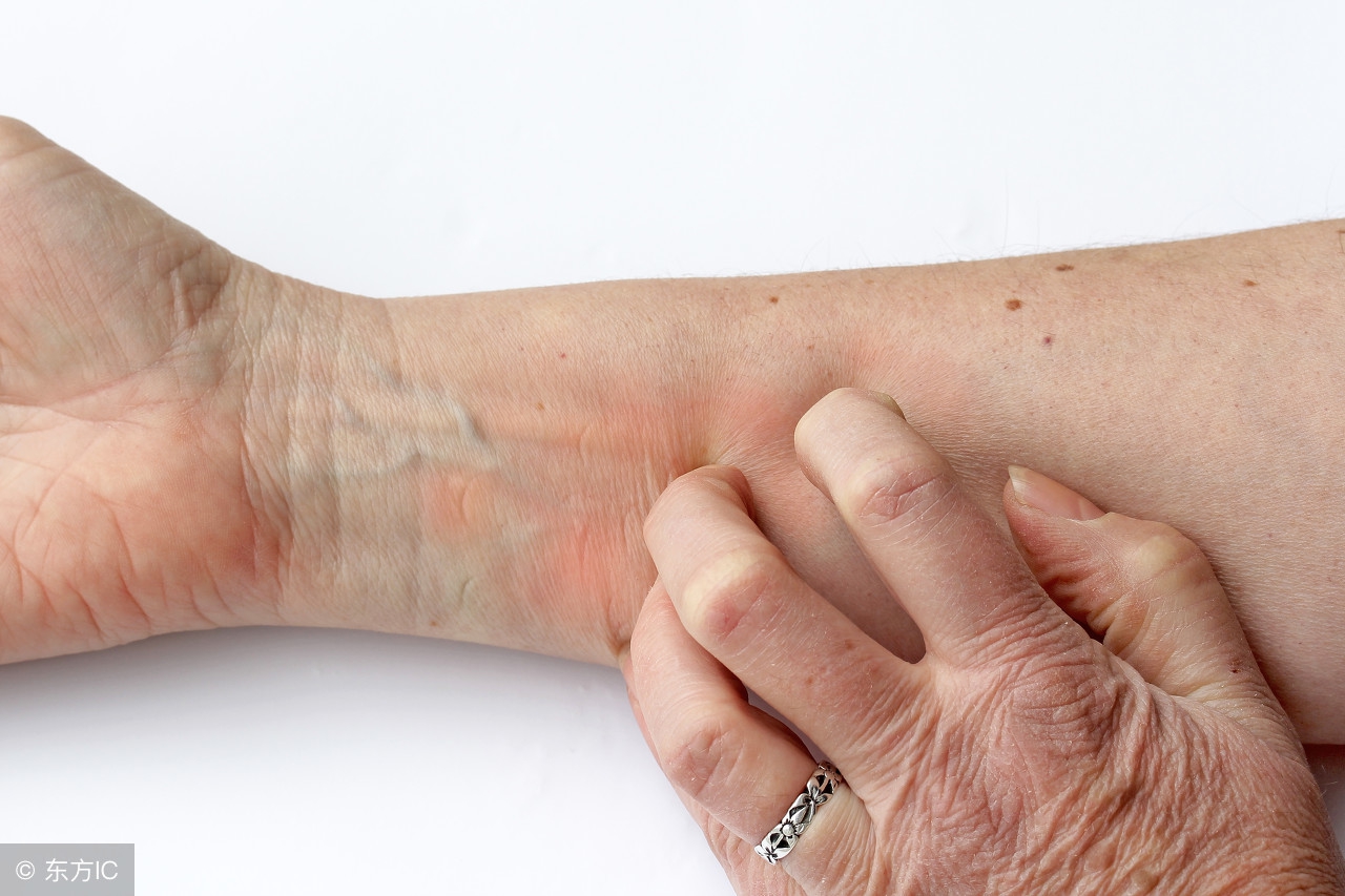 腹股沟湿疹性皮炎怎么治,湿疹脸上大面积发红一般要治多久