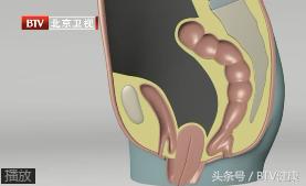 子宫经常跑到体外？北京医院院长说这病得早治！
