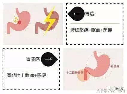 暗红色的便血一定是肠癌吗,大便便血是什么病的预兆