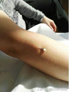 网球肘肌肉酸痛怎么治疗,网球肘部酸痛怎么治疗