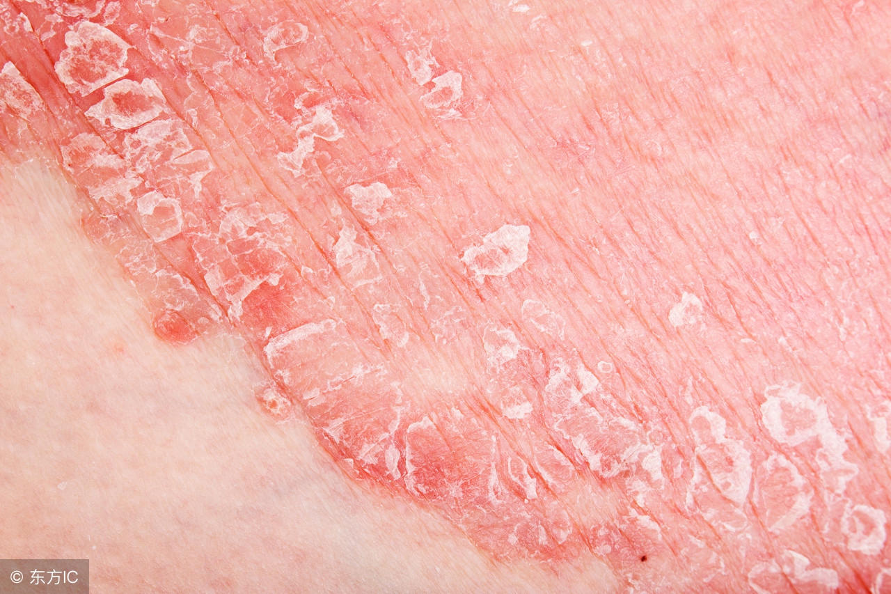 “辣”不起的湿疹病患者要“管住嘴”