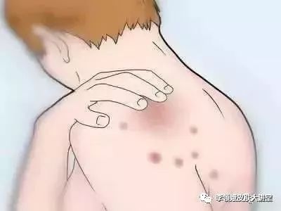 「杏林微资讯」打击痘印，趁早行动！