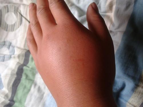 被蜂蛰伤后会怎样,被蜂蜇伤后如何处理