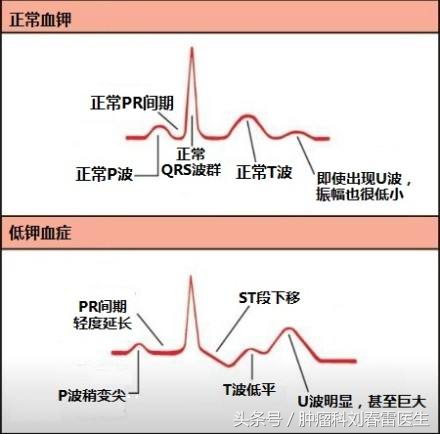 人体如果缺钾，是非常危险的该如何补钾？