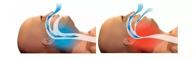 科普健康打呼噜,健康科普知识小儿鼾症的危害