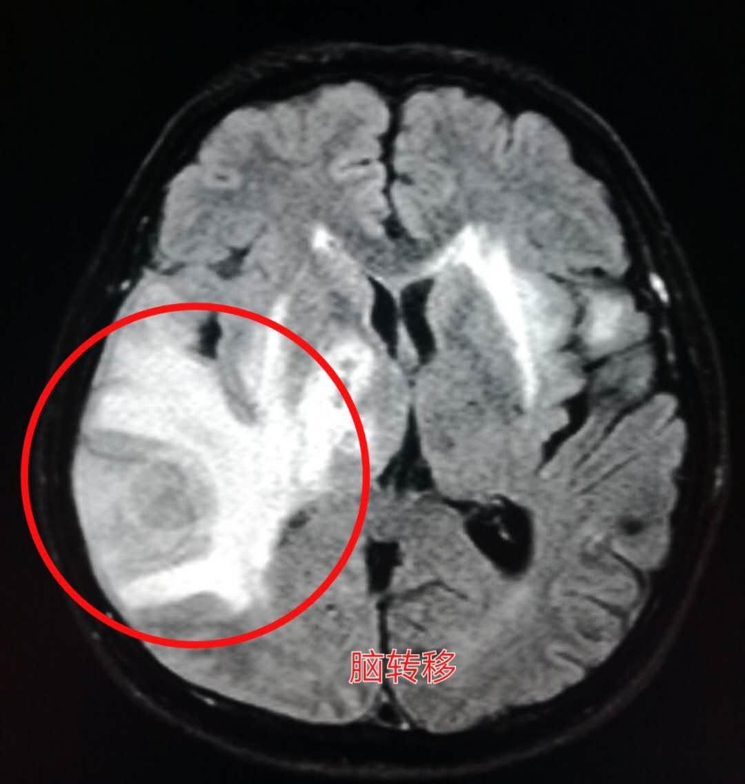 4种症状要查脑血管,这些症状一定要做脑血管造影
