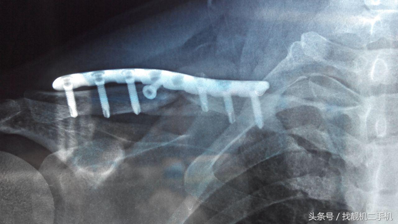 病人碎裂的骨头，医生是怎么修复的？