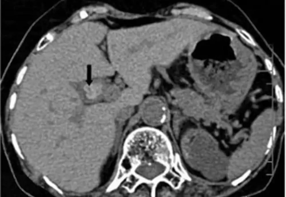 肠息肉和胆囊息肉必须做手术吗,肠息肉切除好还是不切除好