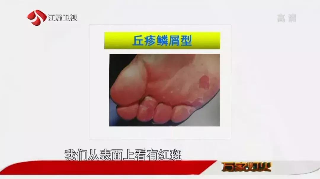 经常去足疗会得脚气吗,去洗脚感染脚气怎么办