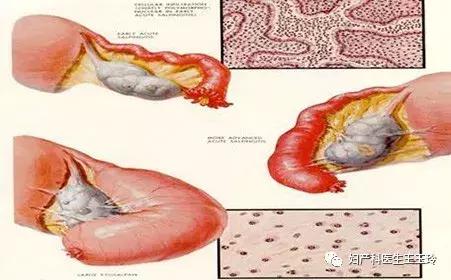 无孔腹腔镜手术,单孔腹腔镜手术如何做