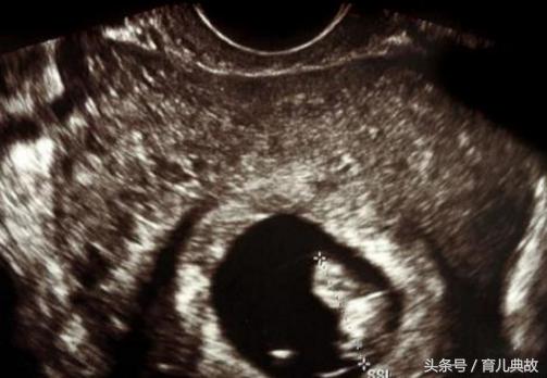 什么时候b超单胎变双胎,单胎变双胎23周