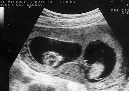 什么时候b超单胎变双胎,单胎变双胎23周