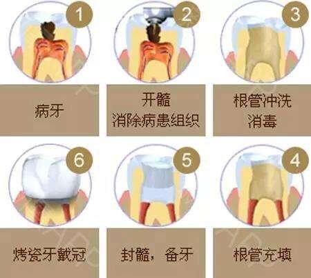 根管治疗后牙齿一定要装牙套吗,根管治疗戴牙冠后有什么感觉